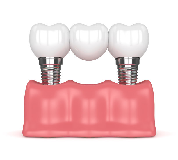 种植体与牙桥的3d渲染图片下载