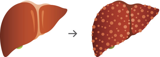 肝硬化图片下载