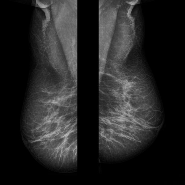 乳房x光检查图片下载