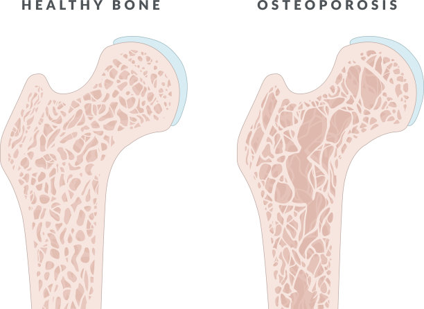 插图显示健康的骨骼和骨质疏松症图片下载