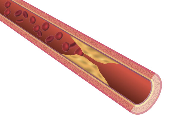 动脉硬化图片下载