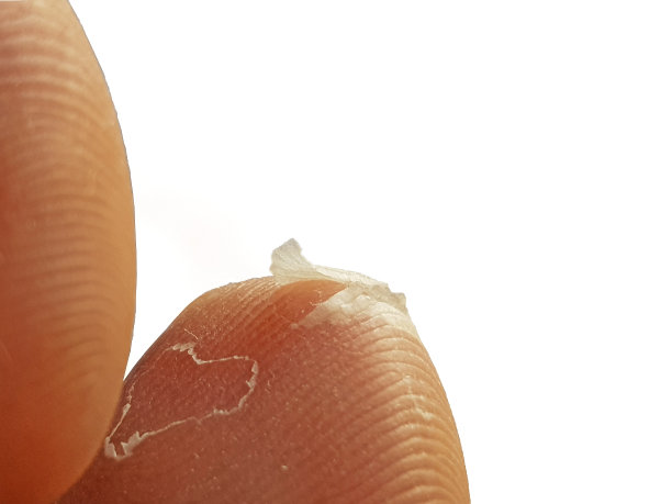 干燥的足趾剥离接触皮炎真菌感染皮肤接触感染素材图片