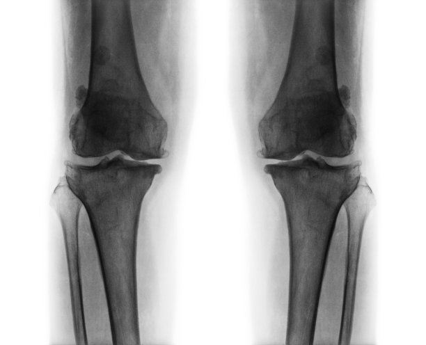 双膝骨关节炎。图片下载
