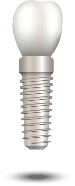 向量现实牙科种植孤立在白色。图片下载