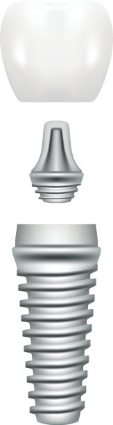 牙种植体结构医学图片教育信息图与磨牙替换端健康工具模型在白色背景孤立。矢量图图片下载