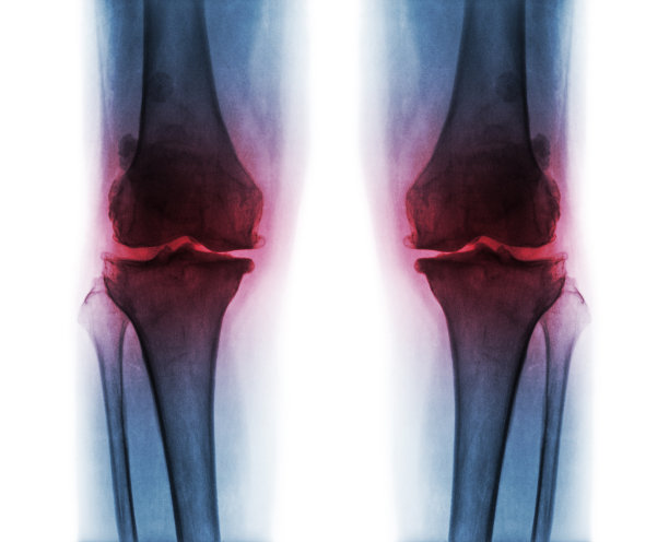 双膝骨关节炎。图片下载