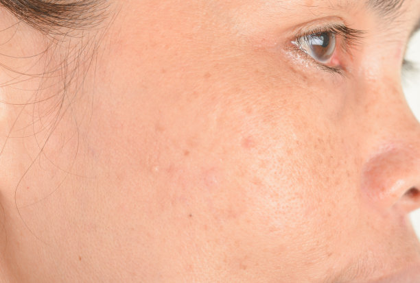 脸上的雀斑图片下载