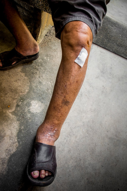 肾病患者的肿胀和腿溃疡图片下载