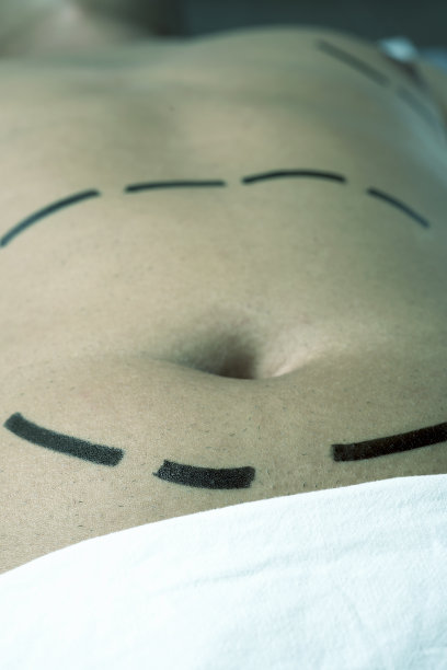 正在做整形手术或抽脂的男人图片下载