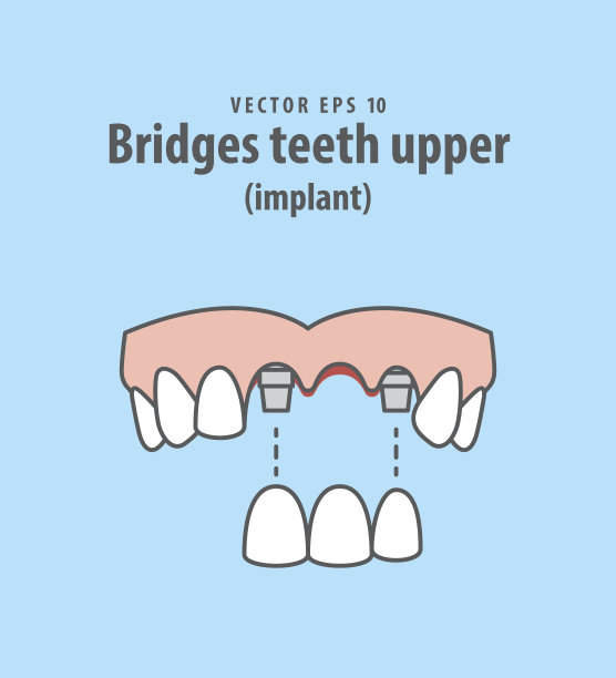 桥牙上(种植体)插图矢量在蓝色的背景。牙科的概念。素材图片