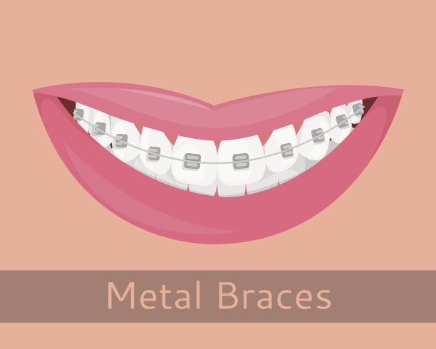 牙齿矫正，微笑的嘴唇卡通风格孤立。带牙套的微笑，口腔医学主题插图，正畸，牙齿对齐，咬合矫正，矢量插图图片下载