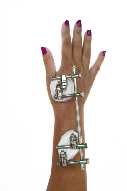 矫形术，用假体治疗断臂图片下载