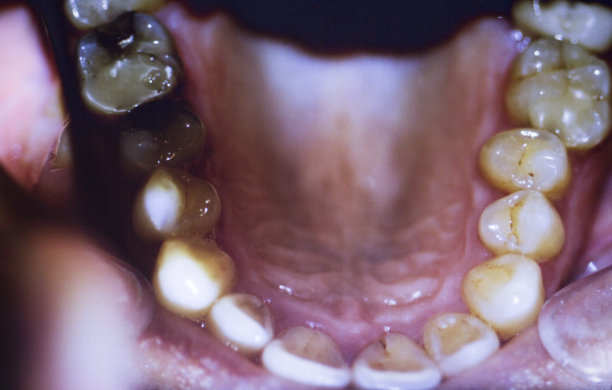 牙科医生的牙齿照片显示牙齿不整齐的门牙和牙菌斑。图片下载