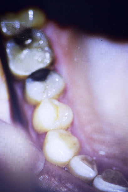 牙科医生的牙齿照片显示牙齿不整齐的门牙和牙菌斑。图片下载