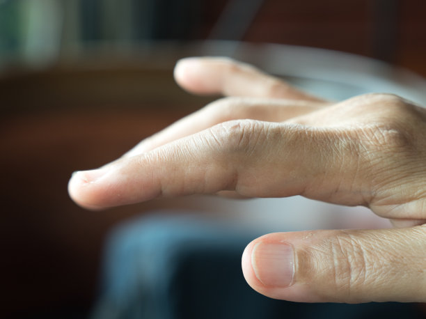 类风湿关节炎患者的手图片下载