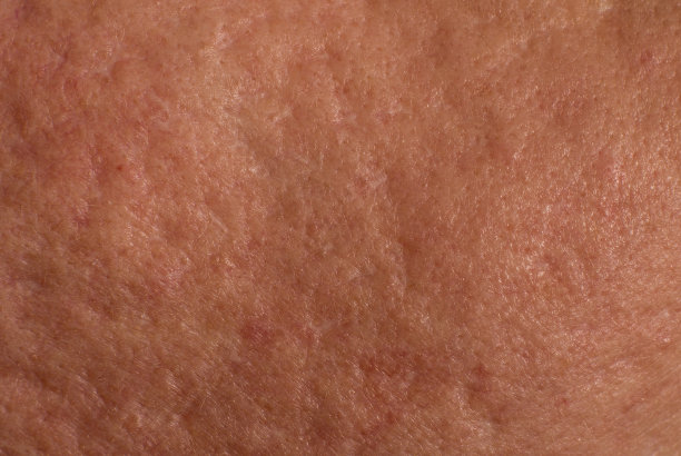 皮肤痤疮疤痕图片下载