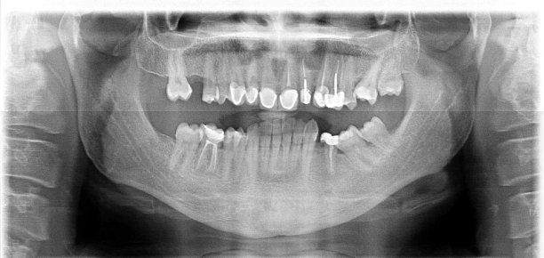 牙科x光片图片下载