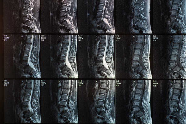 人类脊柱椎间盘突出和脊椎滑脱的磁共振图片下载