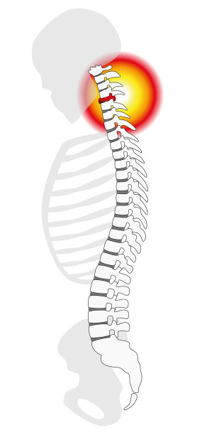颈痛-人体颈椎的椎间盘突出或脱垂。孤立的矢量插图上的白色背景。图片下载
