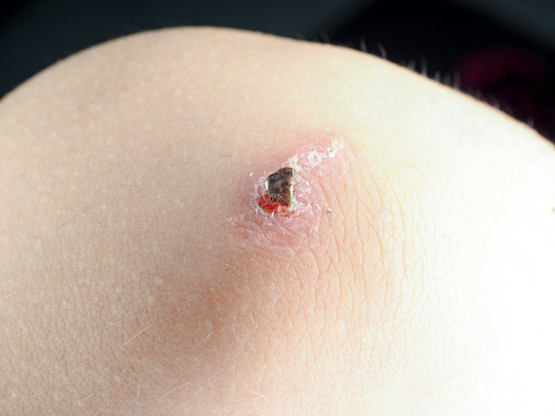 白人儿童膝部开放性伤口感染瘢痕图片下载