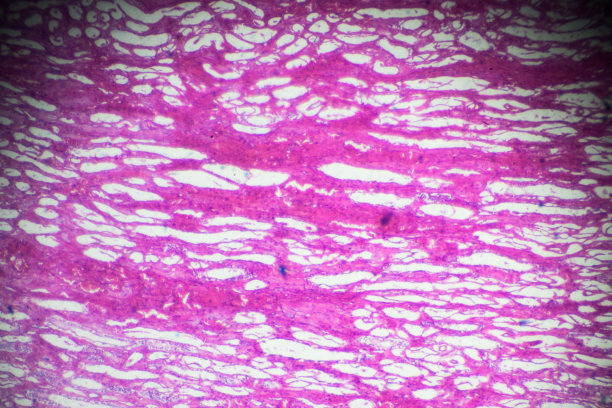 光镜下肾腺癌活检图片下载