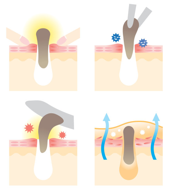 清洁毛孔堵塞治疗。美容护肤理念图片下载