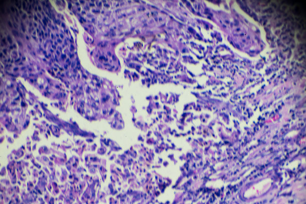 食管癌(高分化鳞状病变)图片下载