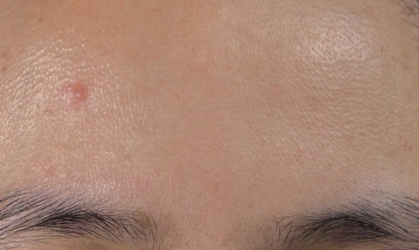 油性皮肤亚洲女人额头上的粉刺。黑头粉刺。素材图片