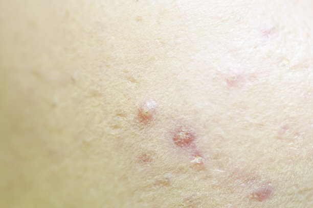 特写脸上的痤疮发炎图片下载