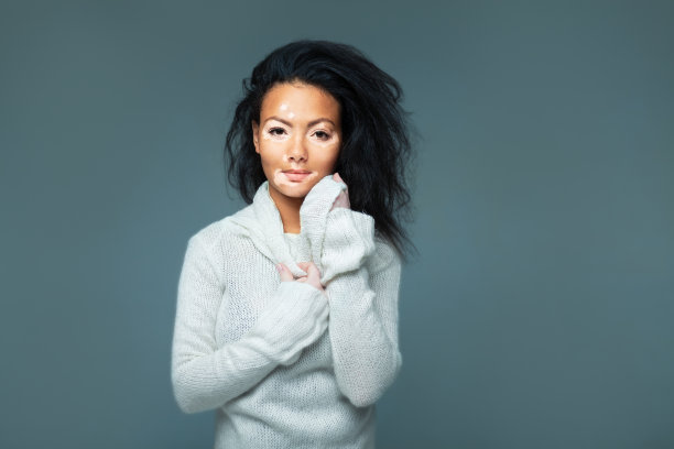 工作室里有皮肤问题的美丽非洲女孩素材图片