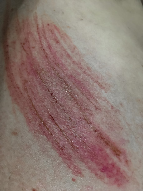 人皮肤上的疤痕图片下载