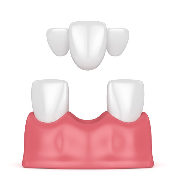 牙齿的3d渲染与牙科马里兰桥图片下载