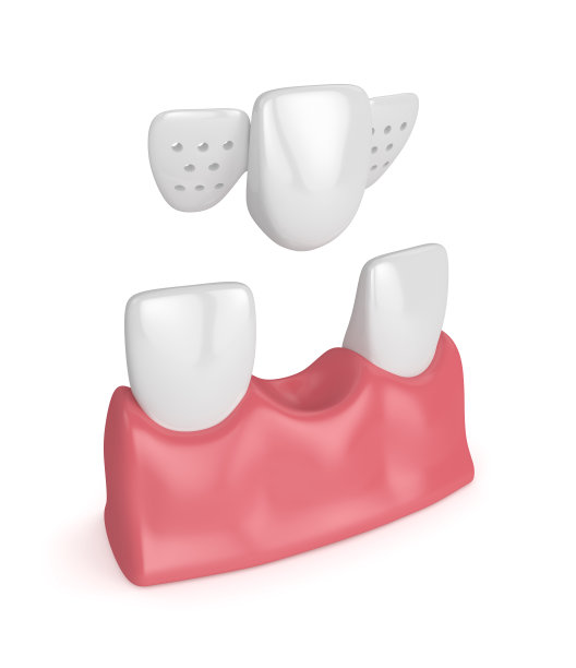 牙齿的3d渲染与牙科马里兰桥图片下载