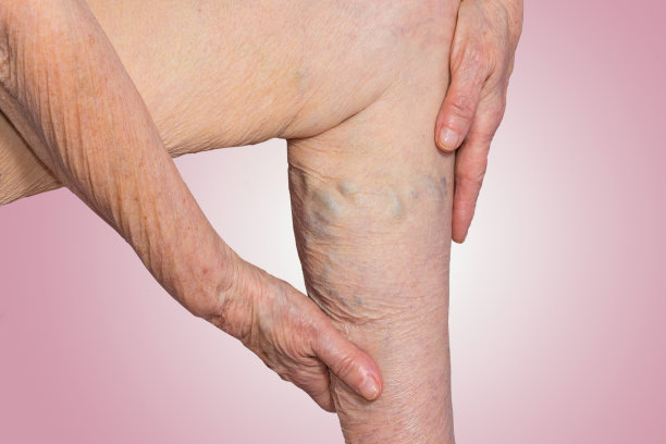 一个用彩色粉笔画的老妇人腿上的静脉曲张图片下载