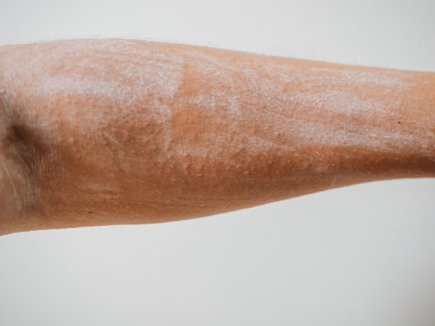 皮肤不好，手上起疹子图片下载