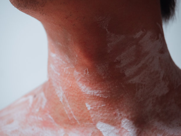 皮肤毛囊外炎，颈部有皮疹图片下载