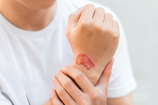 事故后，男子手臂上有损伤或伤口图片下载