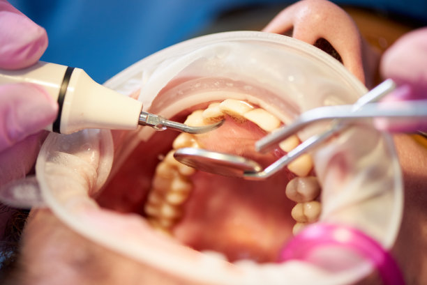 微距照片检查患者的牙垢在一个诊所与创新技术。嘴张得大大的，在牙科诊所里使用镜子和器械图片下载