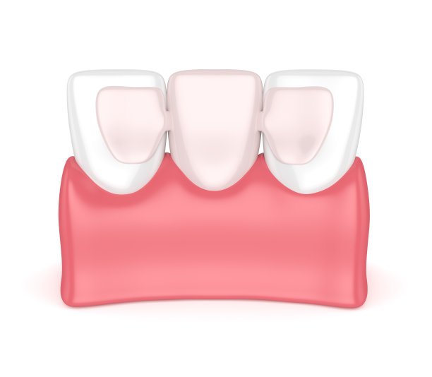 牙齿的3d渲染与牙科马里兰桥图片下载