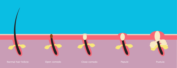 痤疮是一种长期发生的皮肤病。图片下载