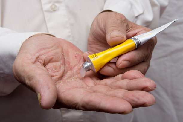 手上有湿疹。老人手上的药膏。使用软膏和润肤乳霜来治疗和滋润皮肤。退休后应用软膏、乳膏治疗湿疹、牛皮癣等皮肤病素材图片