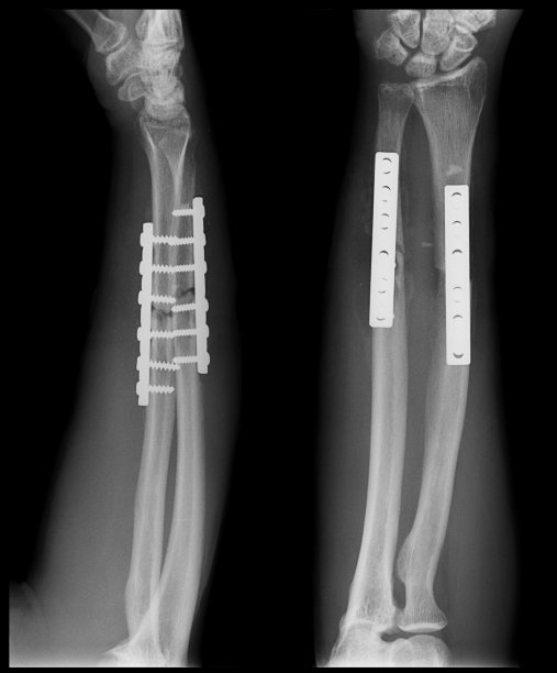 前臂骨折。骨科医生操作，钢板螺钉内固定(术后)图片下载