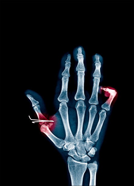 显示拇指和小指骨折的手指X光片，疼痛概念图片下载