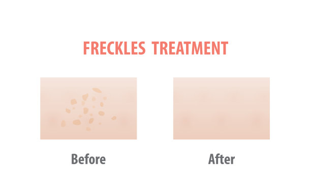 雀斑治疗比较插图向量上的白色背景。皮肤的概念。图片下载