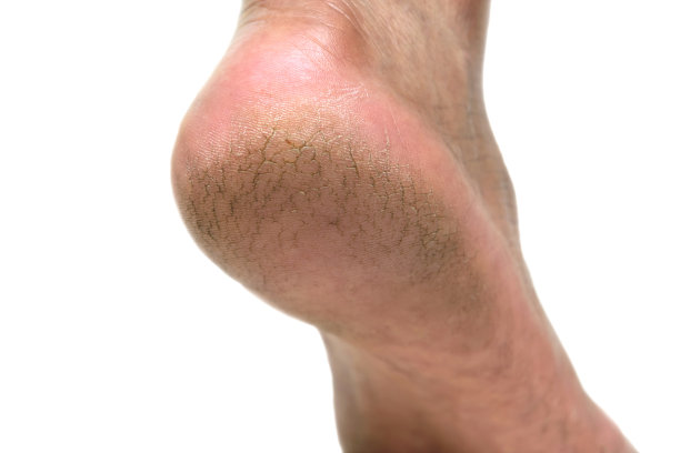 脚后跟开裂，背景孤立。图片下载