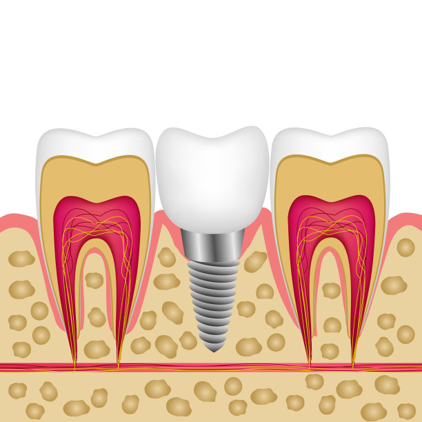 矢量插图的牙齿植入骨之间的小册子，杂志，传单，牙科诊所的网站。图片下载