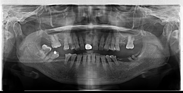全景牙科x光牙齿图像图片下载