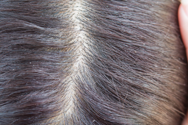 头皮上有头皮屑和黑头发图片下载