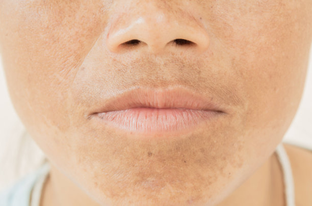 脸上的雀斑图片下载