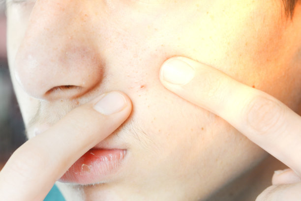 痤疮和皮肤问题图片下载